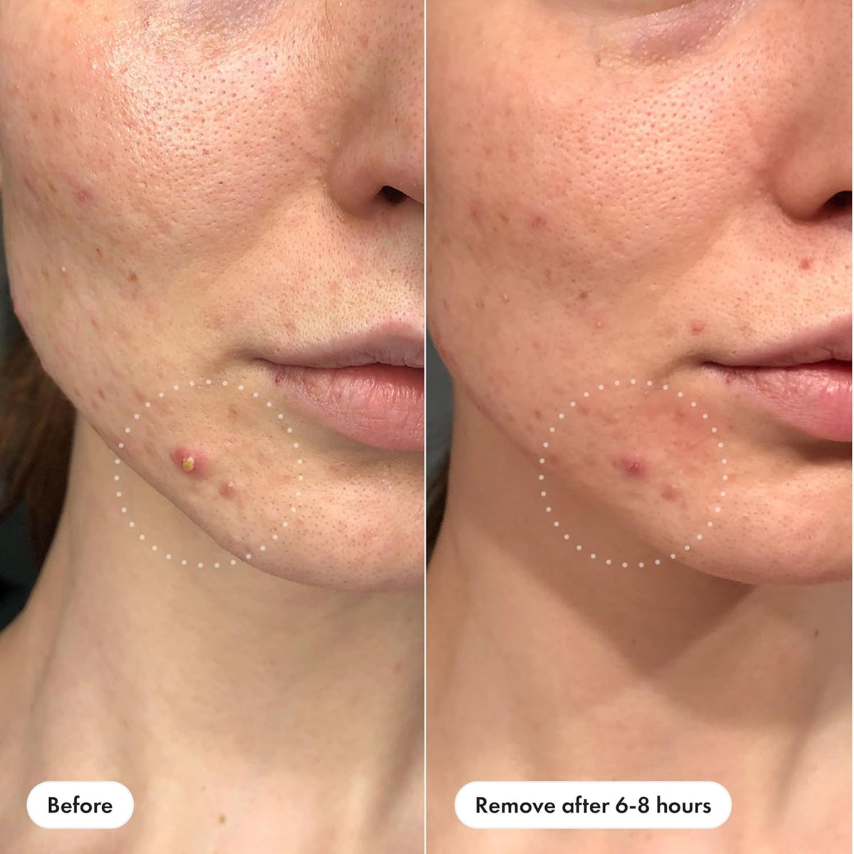 Hero Cosmetics  Invisible+ Daytime Acne Pimple Patch, 72 Ct